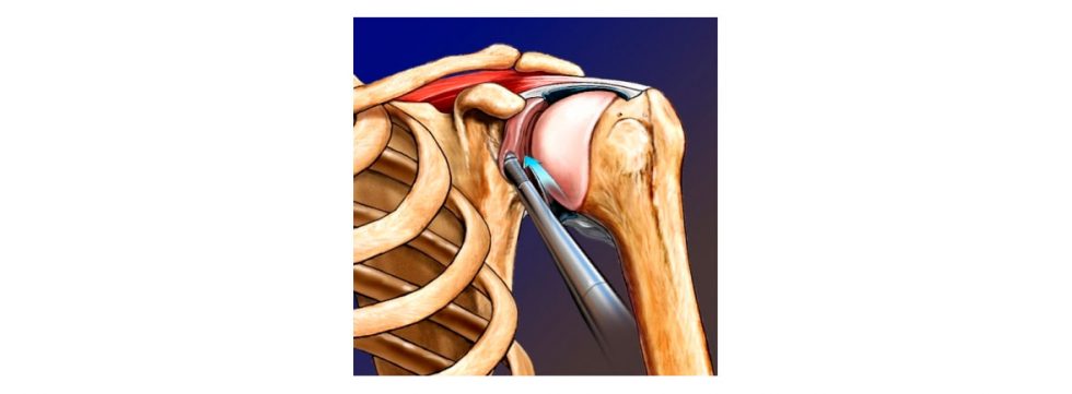 ¿qué Es El Labrum Del Hombro Cirugía De Hombro En Guadalajara Dr Esteban Castroemk 7192